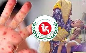 হামের উপসর্গ নিয়ে আরও ৪ শিশুর মৃত্যু