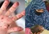 একদিনে হাম সন্দেহে ছয় শিশুর মৃত্যু