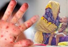 হামের উপসর্গ নিয়ে আরও পাঁচ শিশুর মৃত্যু