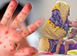 হামের উপসর্গ নিয়ে আরও পাঁচ শিশুর মৃত্যু