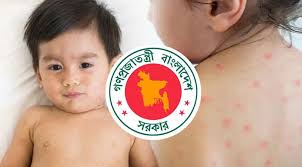 হামের উপসর্গে আরও ৪ শিশুর মৃত্যু
