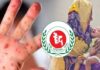 হাম ও হামের উপসর্গে আরও ৫ শিশুর মৃত্যু