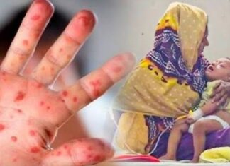 হামের উপসর্গ নিয়ে আরও ৭ শিশুর মৃত্যু